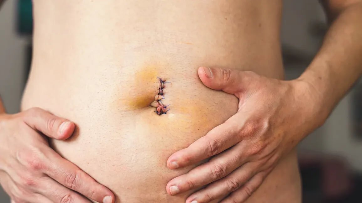 How Long Does It Take for Stitches to Dissolve? The Complete Guide